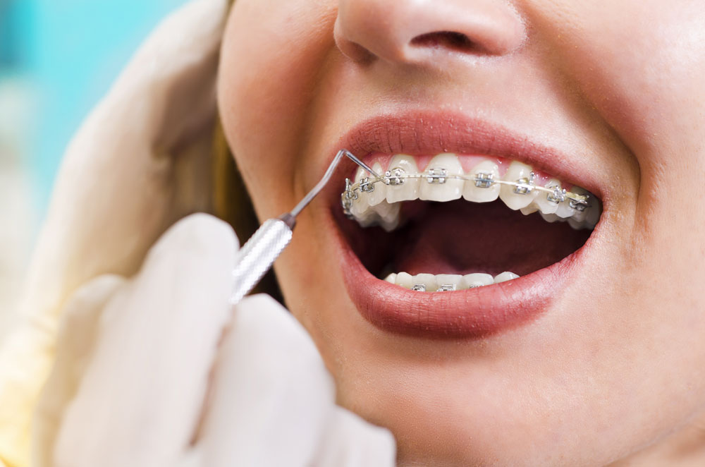 ortodonti-nedir-nasil-tedavi-edilir_20180226134509_1